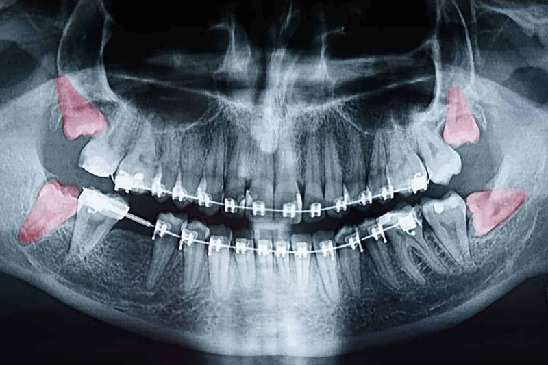 wisdom teeth xray